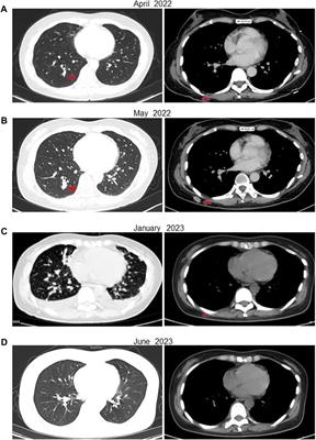 Case report: successful response to bevacizumab combined with erlotinib for a novel FH gene mutation hereditary leiomyoma and renal cell carcinoma